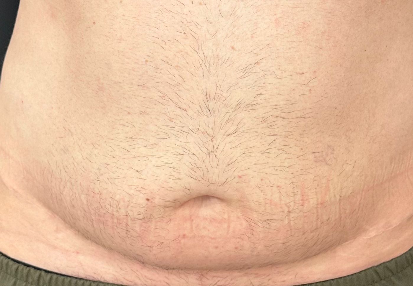 Como fica o umbigo após uma abdominoplastia