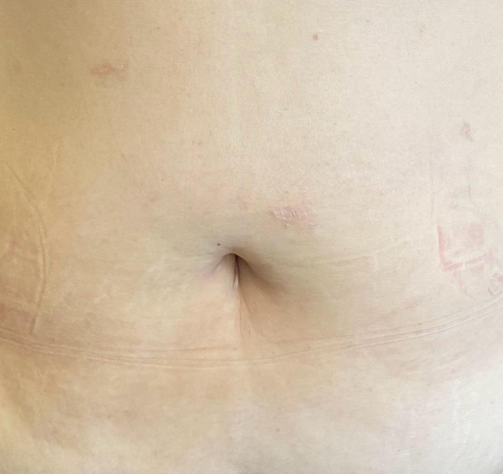 Como fica o umbigo após uma abdominoplastia