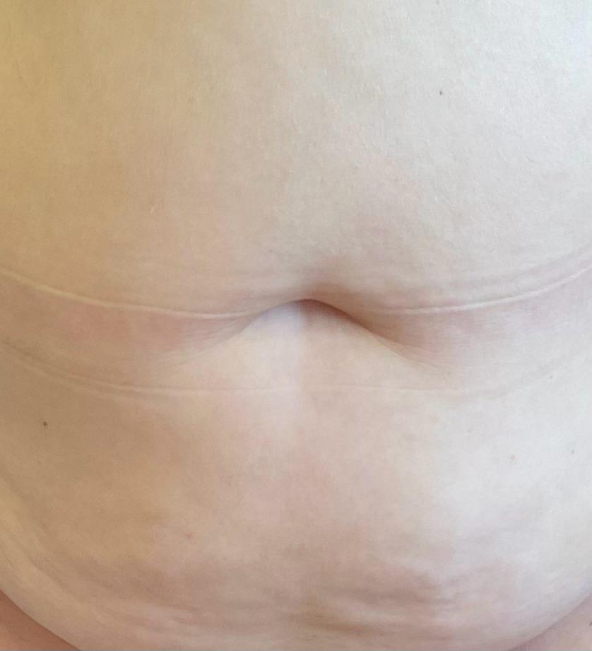 Como fica o umbigo após uma abdominoplastia