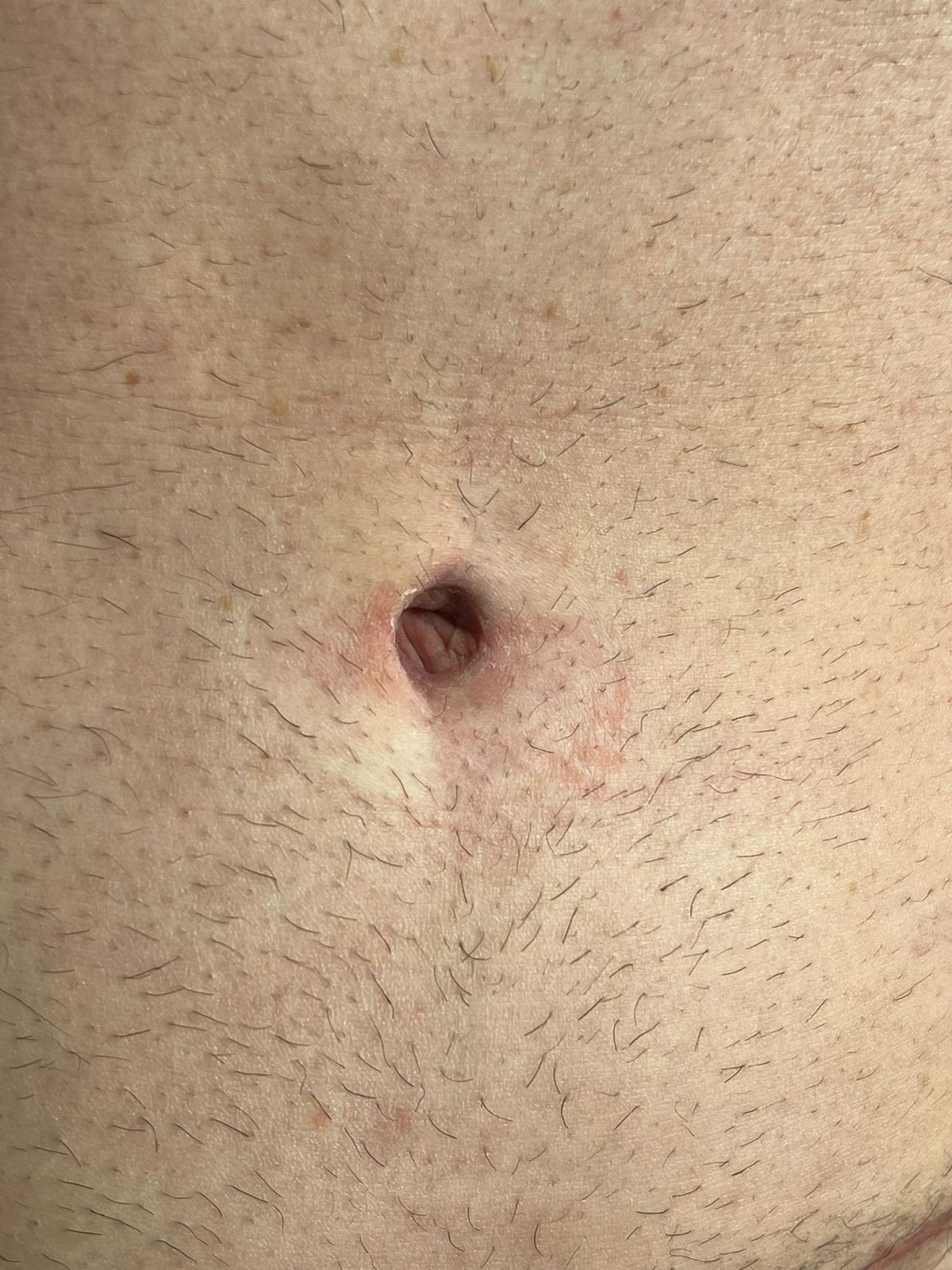 Como fica o umbigo após uma abdominoplastia Como fica o umbigo após uma abdominoplastia